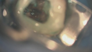 歯科顕微鏡を用いた根管治療